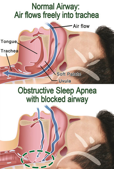 sleep apnea, 睡眠窒息症, OSA, sleep, 睡眠問題, airway, 呼吸氣道