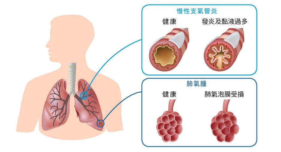 慢性阻塞性肺病