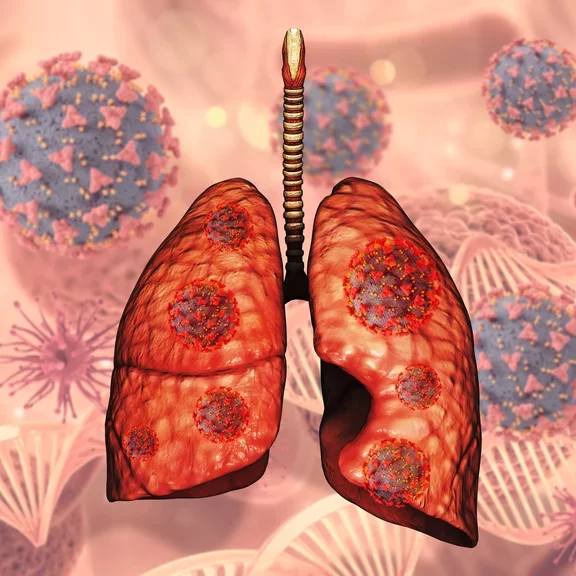 Lung infected by COPD